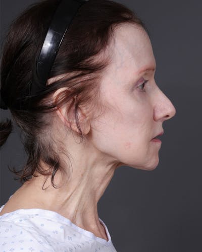 Neck Lift Before & After Gallery - Patient 281882 - Image 1
