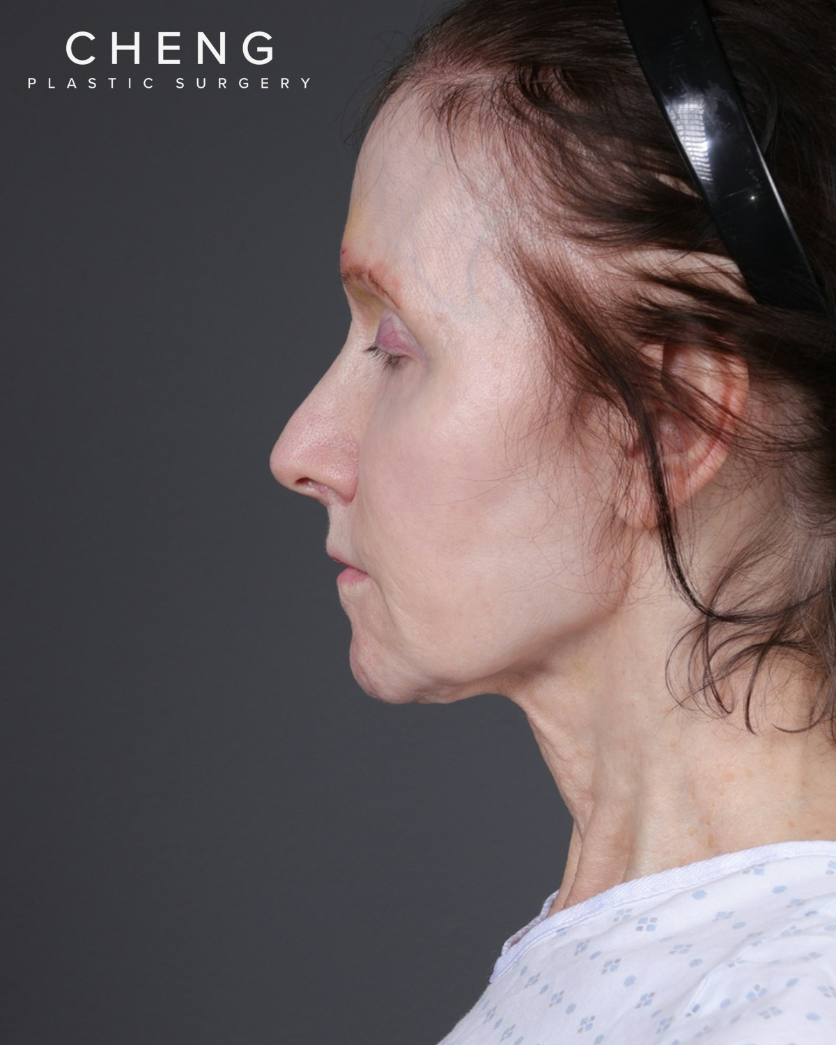 Facelift Before & After Gallery - Patient 681791 - Image 3