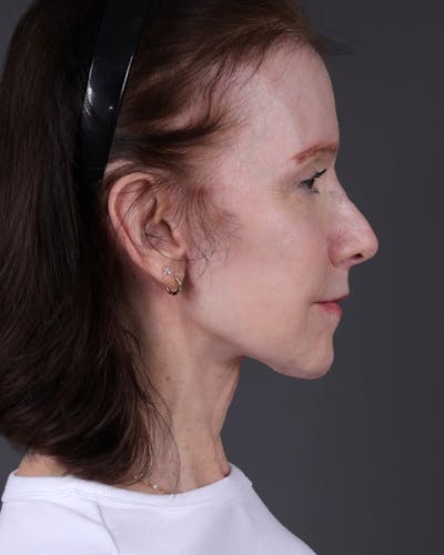 Neck Lift Before & After Gallery - Patient 281882 - Image 2
