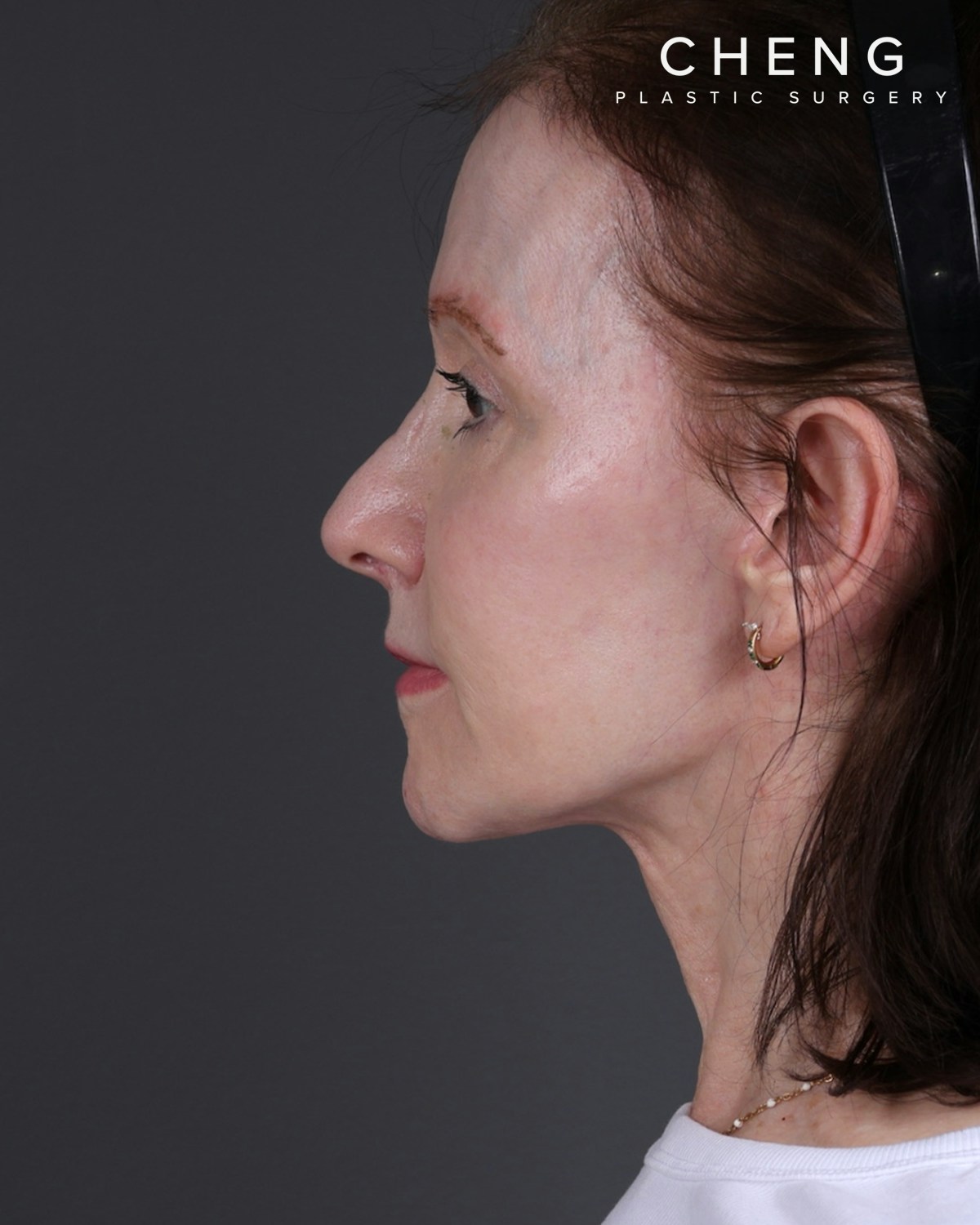 Facelift Before & After Gallery - Patient 681791 - Image 4
