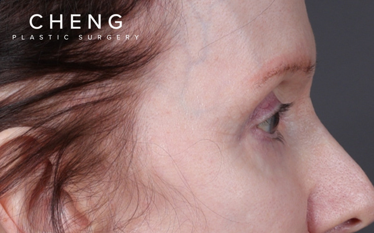 Brow Lift Before & After Gallery - Patient 147613 - Image 1