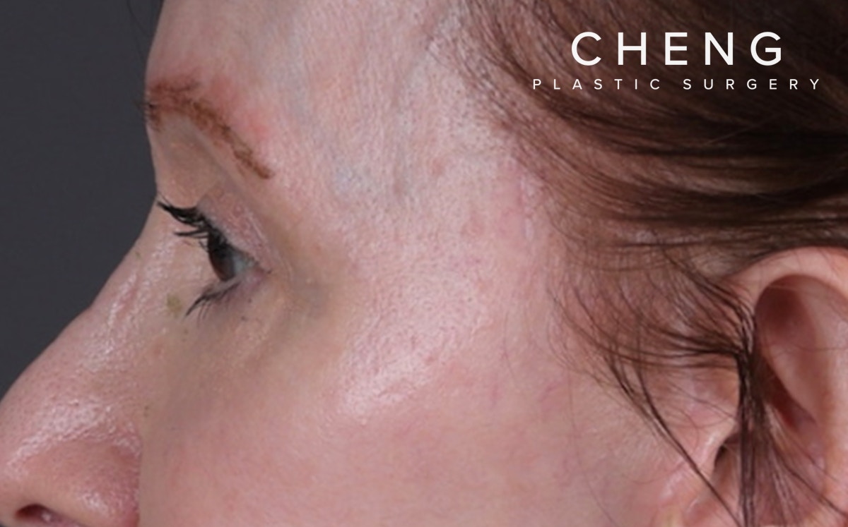 Brow Lift Before & After Gallery - Patient 147613 - Image 4