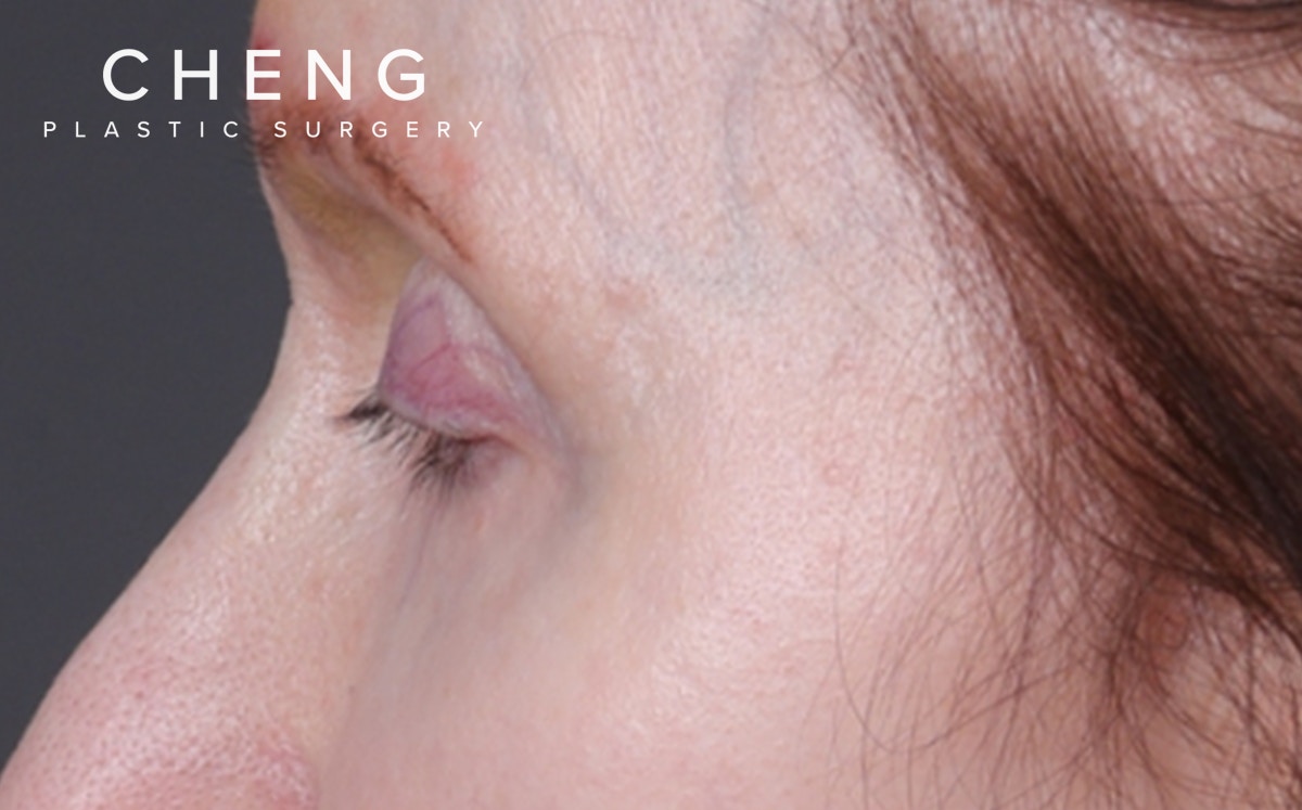 Brow Lift Before & After Gallery - Patient 147613 - Image 3