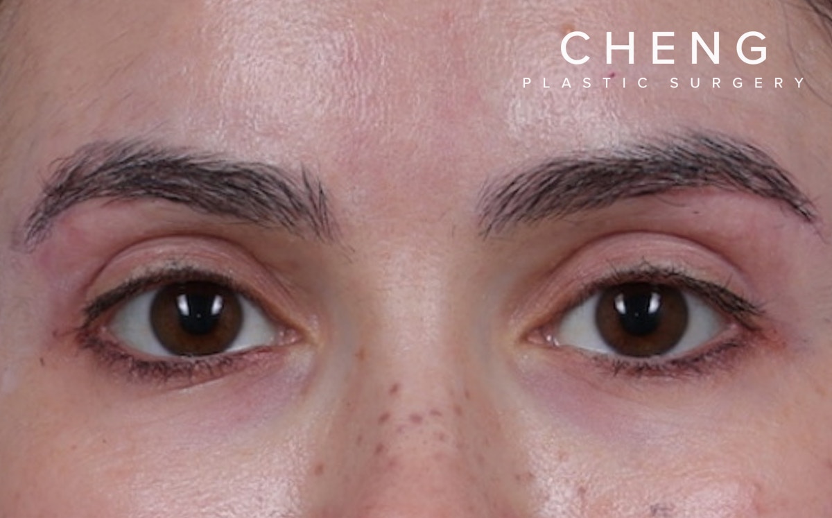 Brow Lift Before & After Gallery - Patient 195460 - Image 2