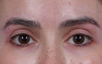 Brow Lift Before & After Gallery - Patient 195460 - Image 2