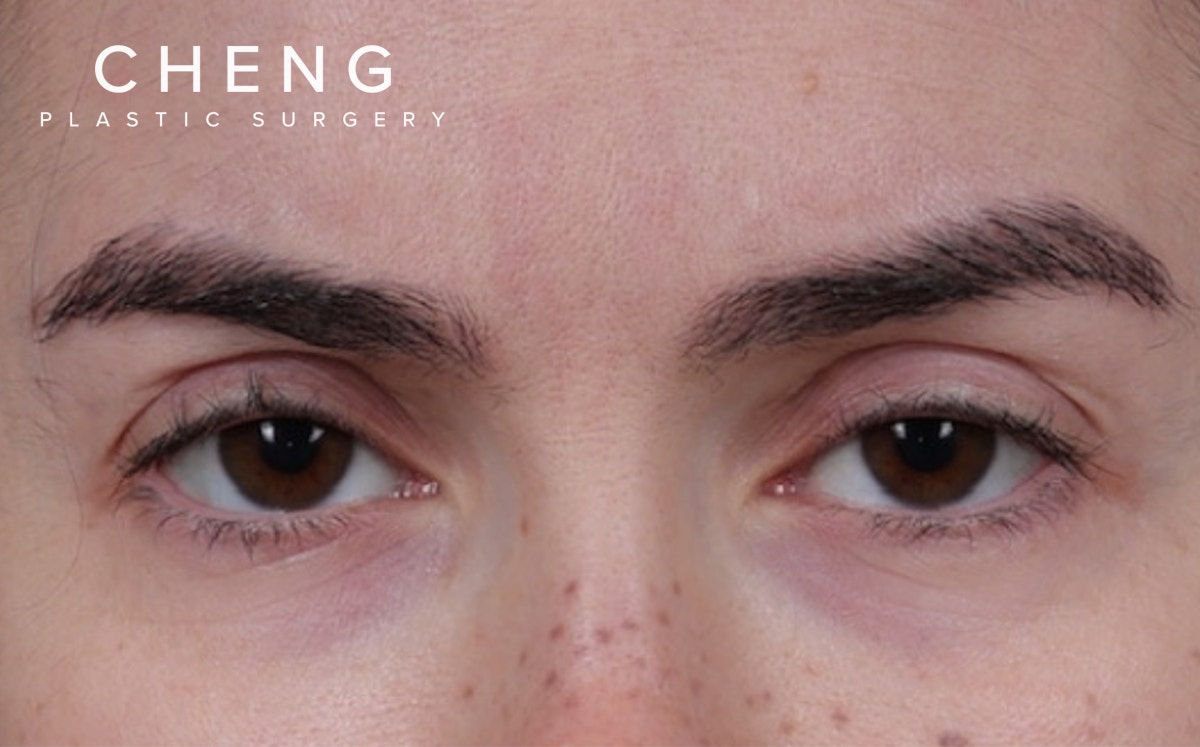 Brow Lift Before & After Gallery - Patient 195460 - Image 1