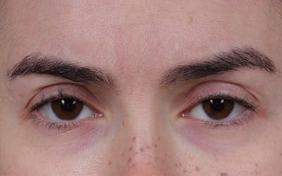 Brow Lift Before & After Gallery - Patient 195460 - Image 1