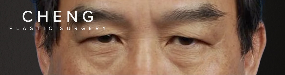 Blepharoplasty Before & After Gallery - Patient 232957 - Image 1