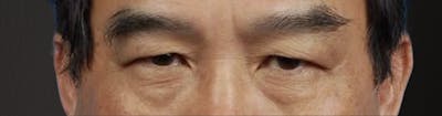 Blepharoplasty Before & After Gallery - Patient 232957 - Image 1