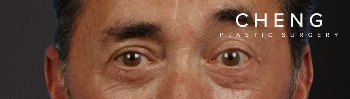 Blepharoplasty Before & After Gallery - Patient 289939 - Image 2