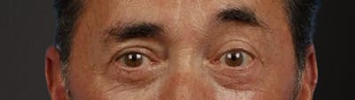 Blepharoplasty Before & After Gallery - Patient 289939 - Image 2