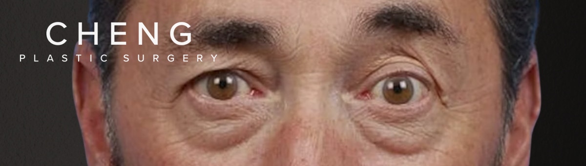 Blepharoplasty Before & After Gallery - Patient 289939 - Image 1