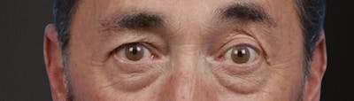 Blepharoplasty Before & After Gallery - Patient 289939 - Image 1