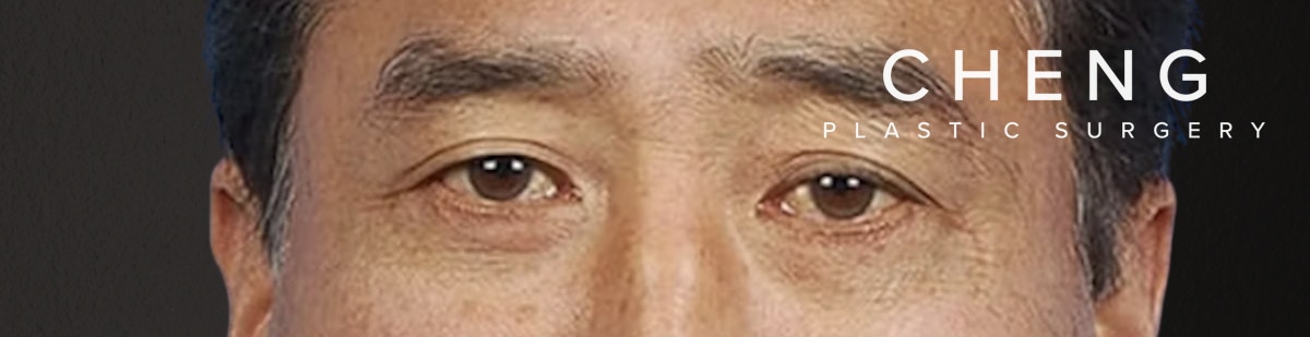 Blepharoplasty Before & After Gallery - Patient 481320 - Image 2