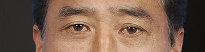 Blepharoplasty Before & After Gallery - Patient 481320 - Image 2
