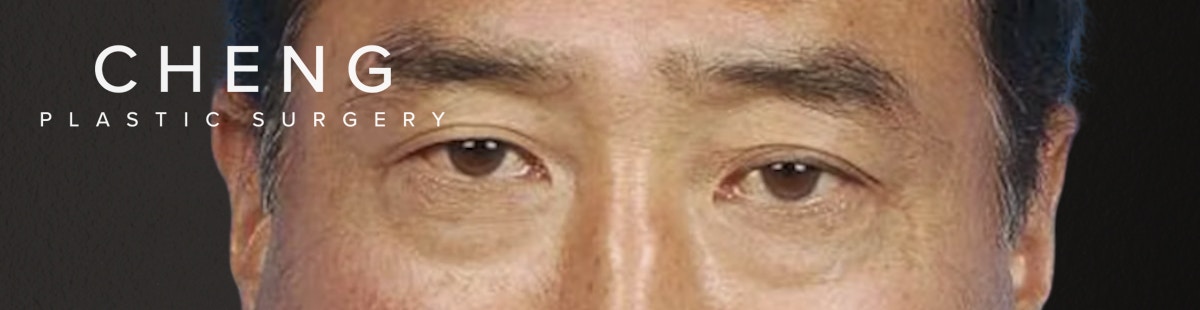 Blepharoplasty Before & After Gallery - Patient 481320 - Image 1