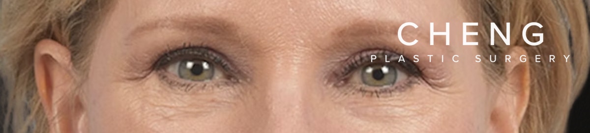 Blepharoplasty Before & After Gallery - Patient 216006 - Image 2