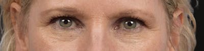 Blepharoplasty Before & After Gallery - Patient 216006 - Image 1
