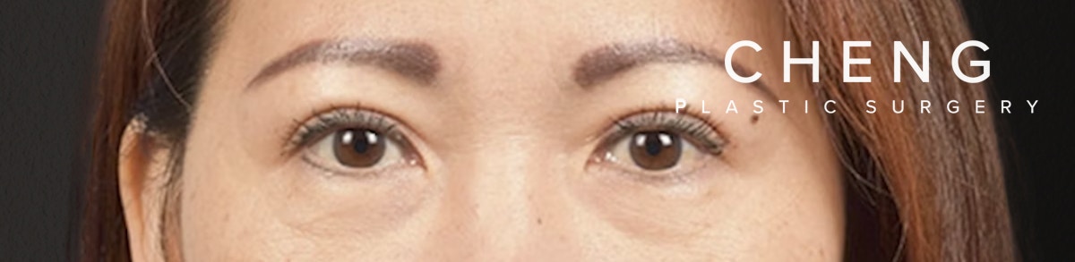 Blepharoplasty Before & After Gallery - Patient 252264 - Image 2