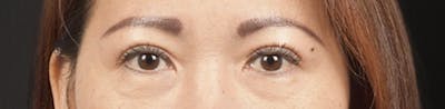Blepharoplasty Before & After Gallery - Patient 252264 - Image 2