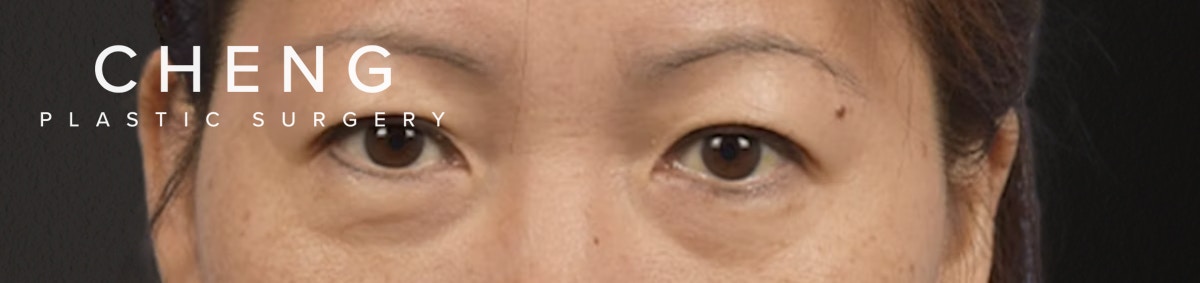 Blepharoplasty Before & After Gallery - Patient 252264 - Image 1