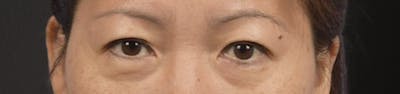 Blepharoplasty Before & After Gallery - Patient 252264 - Image 1