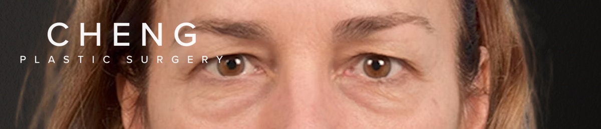 Blepharoplasty Before & After Gallery - Patient 195497 - Image 1
