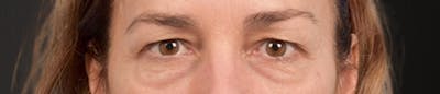 Blepharoplasty Before & After Gallery - Patient 195497 - Image 1