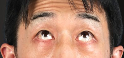 Blepharoplasty Before & After Gallery - Patient 659679 - Image 2