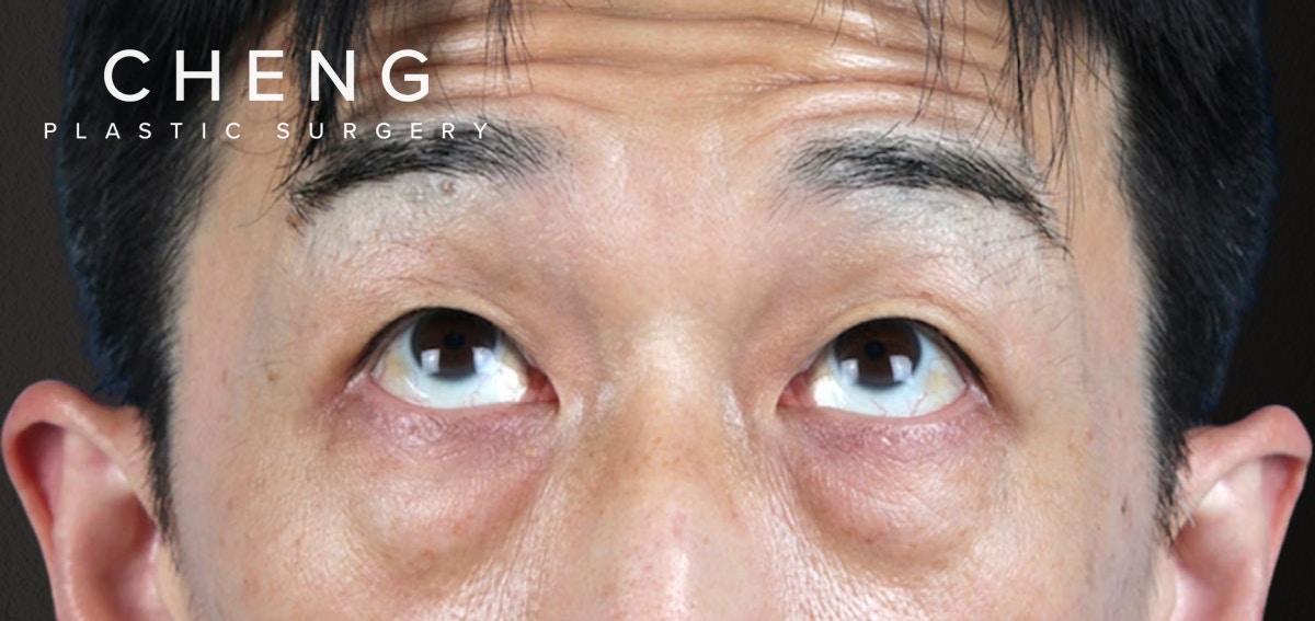 Blepharoplasty Before & After Gallery - Patient 659679 - Image 1