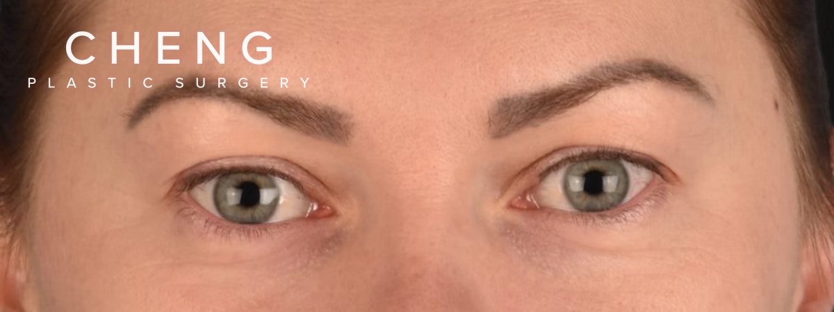 Blepharoplasty Before & After Gallery - Patient 386554 - Image 1