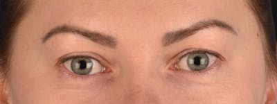 Blepharoplasty Before & After Gallery - Patient 386554 - Image 1