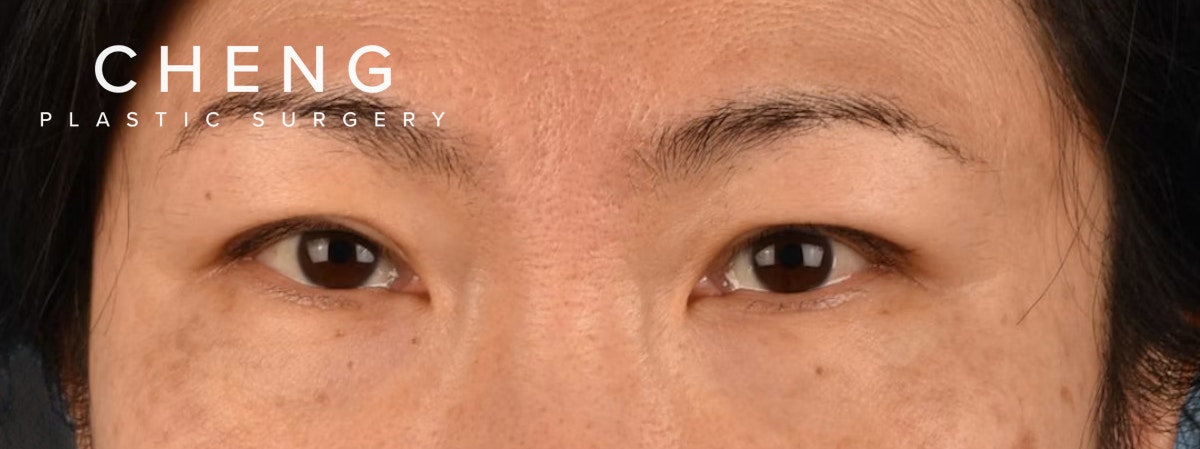 Blepharoplasty Before & After Gallery - Patient 212914 - Image 1
