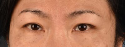 Blepharoplasty Before & After Gallery - Patient 212914 - Image 1