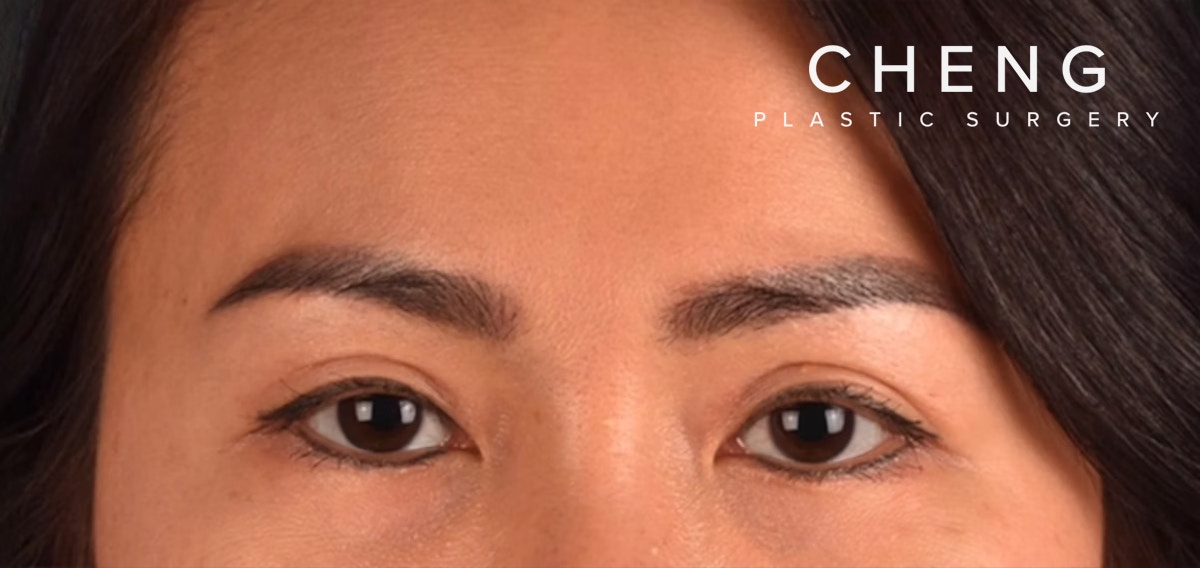Blepharoplasty Before & After Gallery - Patient 301798 - Image 2