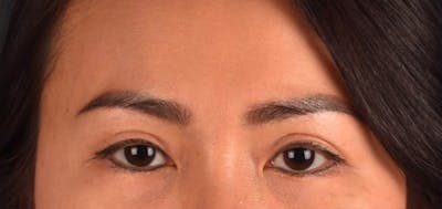 Blepharoplasty Before & After Gallery - Patient 301798 - Image 2