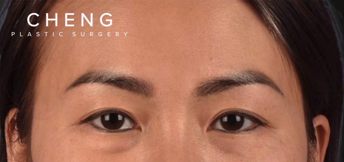 Blepharoplasty Before & After Gallery - Patient 301798 - Image 1