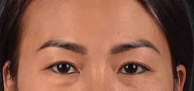 Blepharoplasty Before & After Gallery - Patient 301798 - Image 1