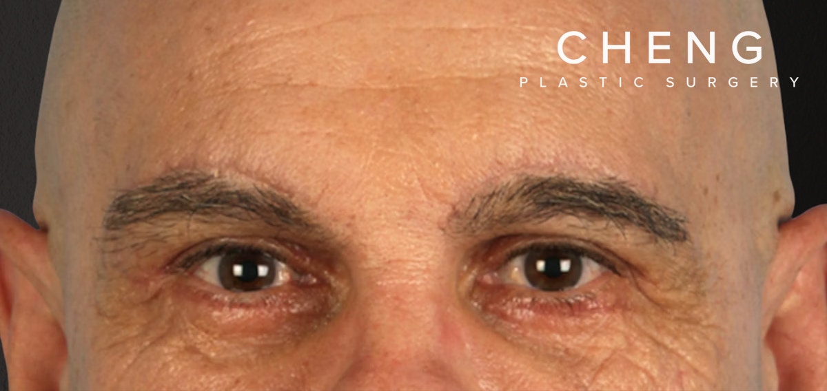 Blepharoplasty Before & After Gallery - Patient 309869 - Image 2