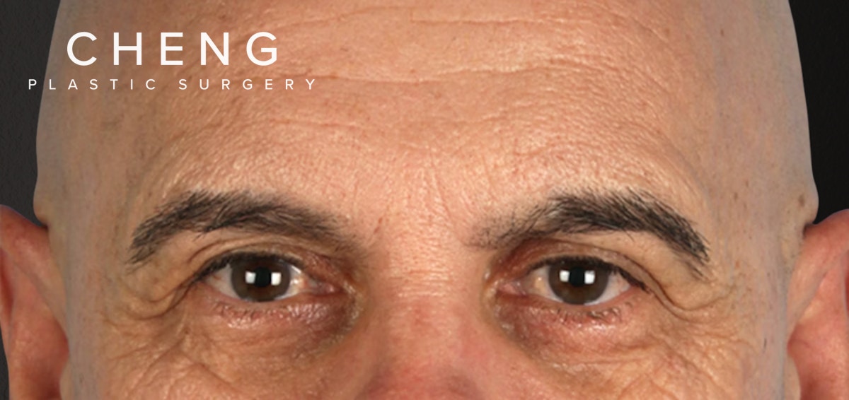 Blepharoplasty Before & After Gallery - Patient 309869 - Image 1