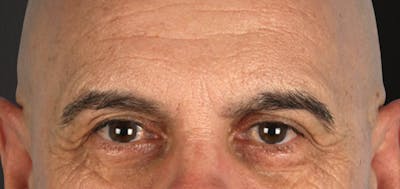 Blepharoplasty Before & After Gallery - Patient 309869 - Image 1