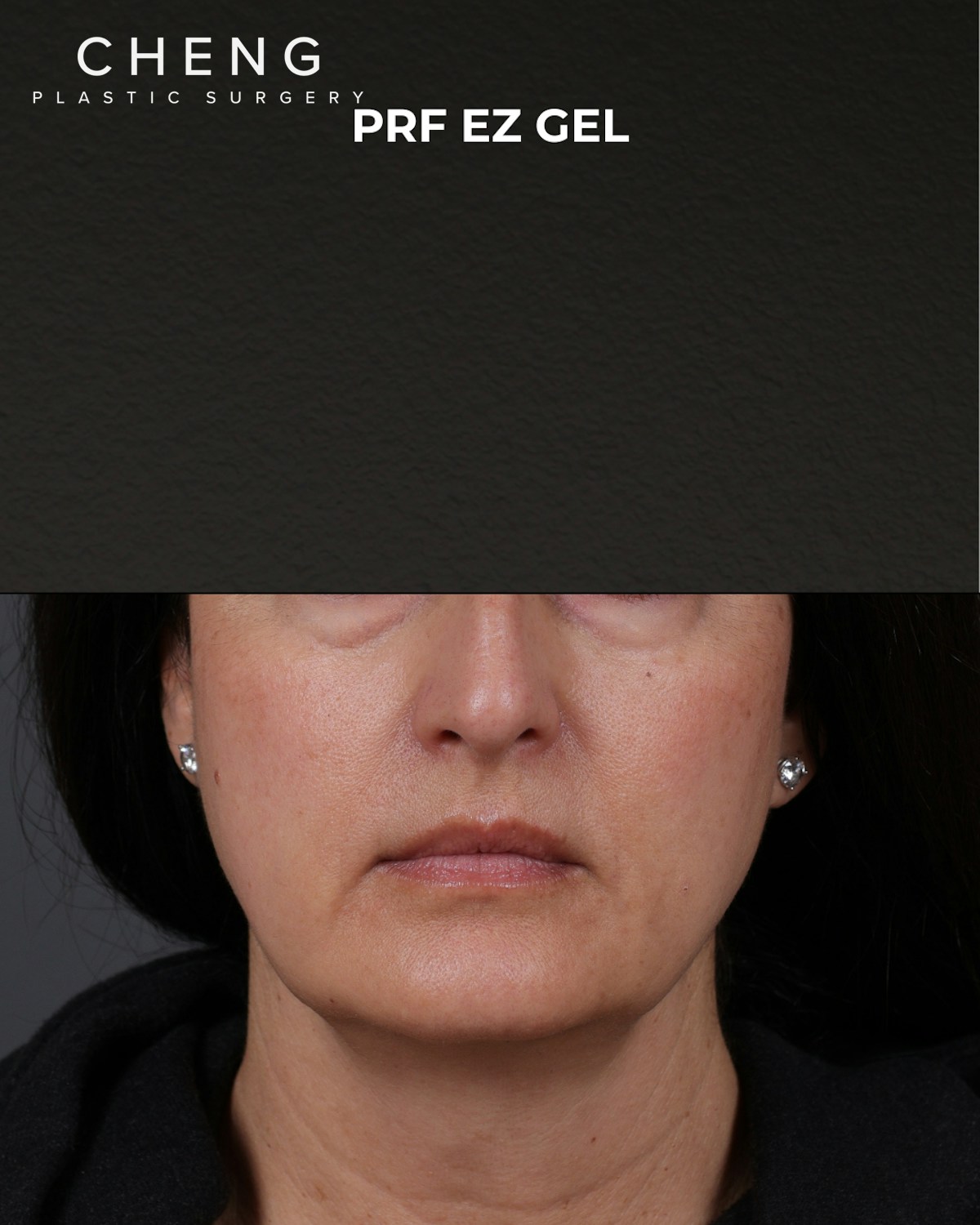 Dermal Fillers Before & After Gallery - Patient 186879 - Image 1