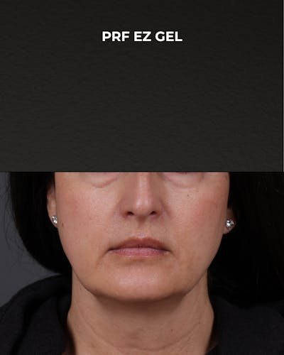 Dermal Fillers Before & After Gallery - Patient 186879 - Image 1