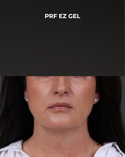 Dermal Fillers Before & After Gallery - Patient 186879 - Image 2