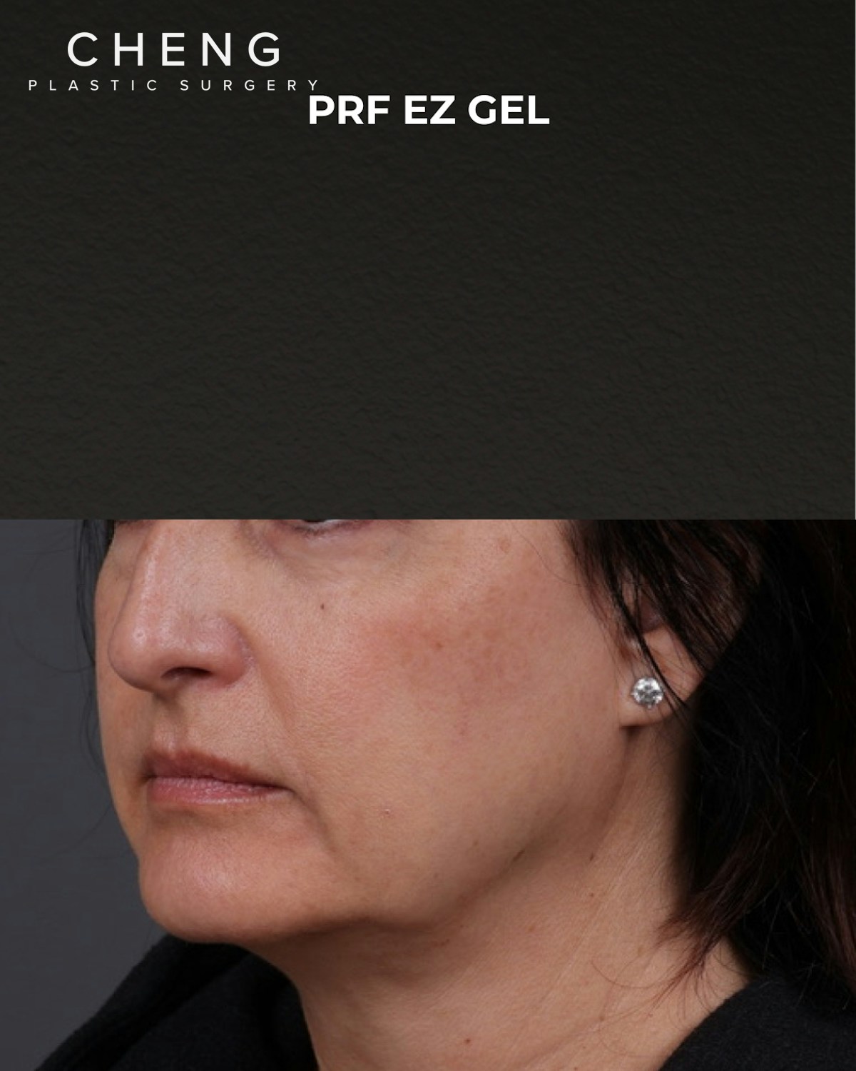 Dermal Fillers Before & After Gallery - Patient 186879 - Image 3