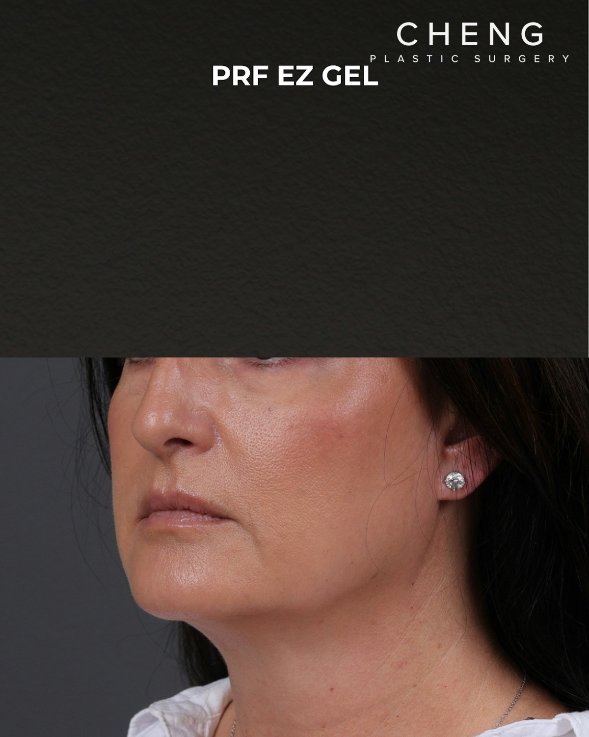 Dermal Fillers Before & After Gallery - Patient 186879 - Image 4