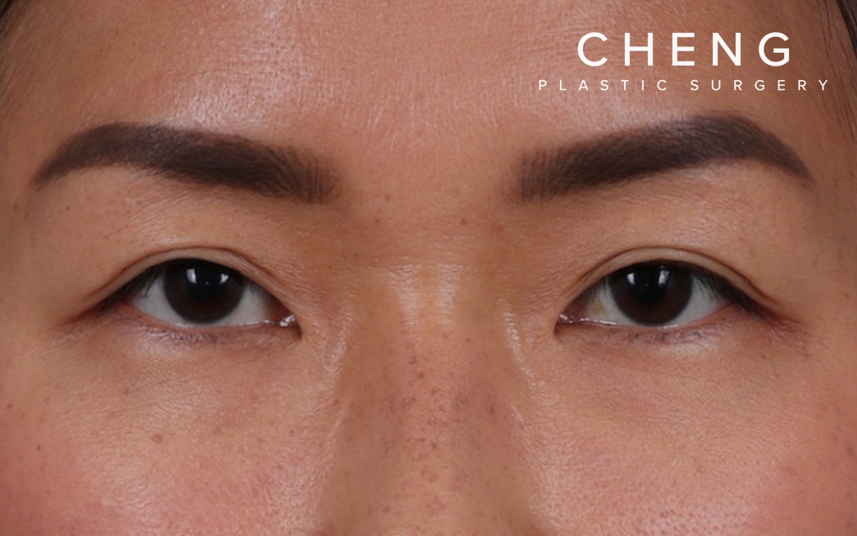 Blepharoplasty Before & After Gallery - Patient 286711 - Image 2
