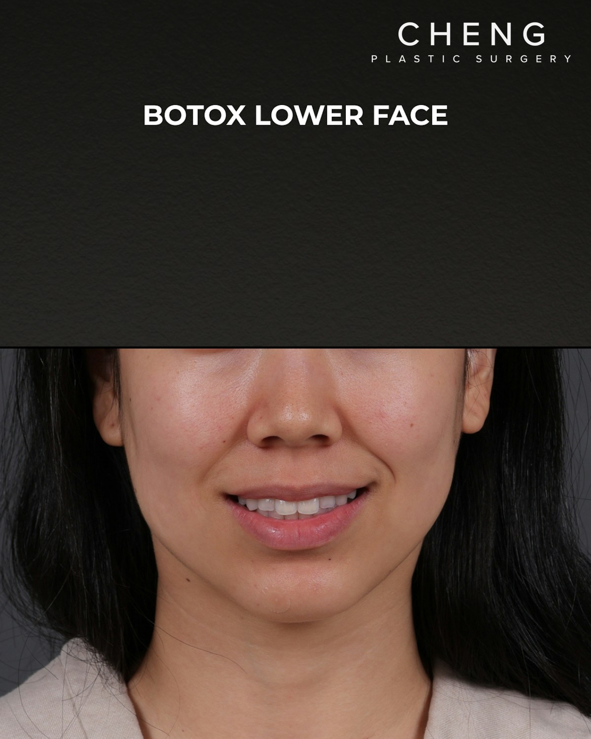 Botox and Dysport Before & After Gallery - Patient 326035 - Image 2
