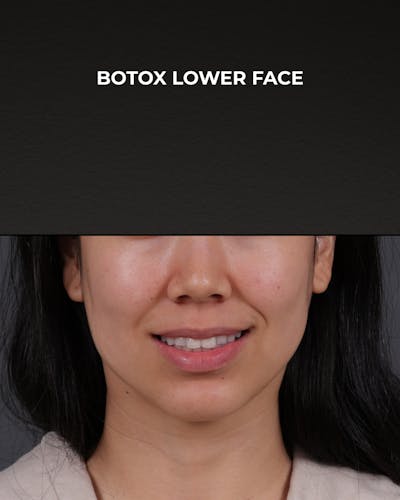 Botox and Dysport Before & After Gallery - Patient 326035 - Image 2