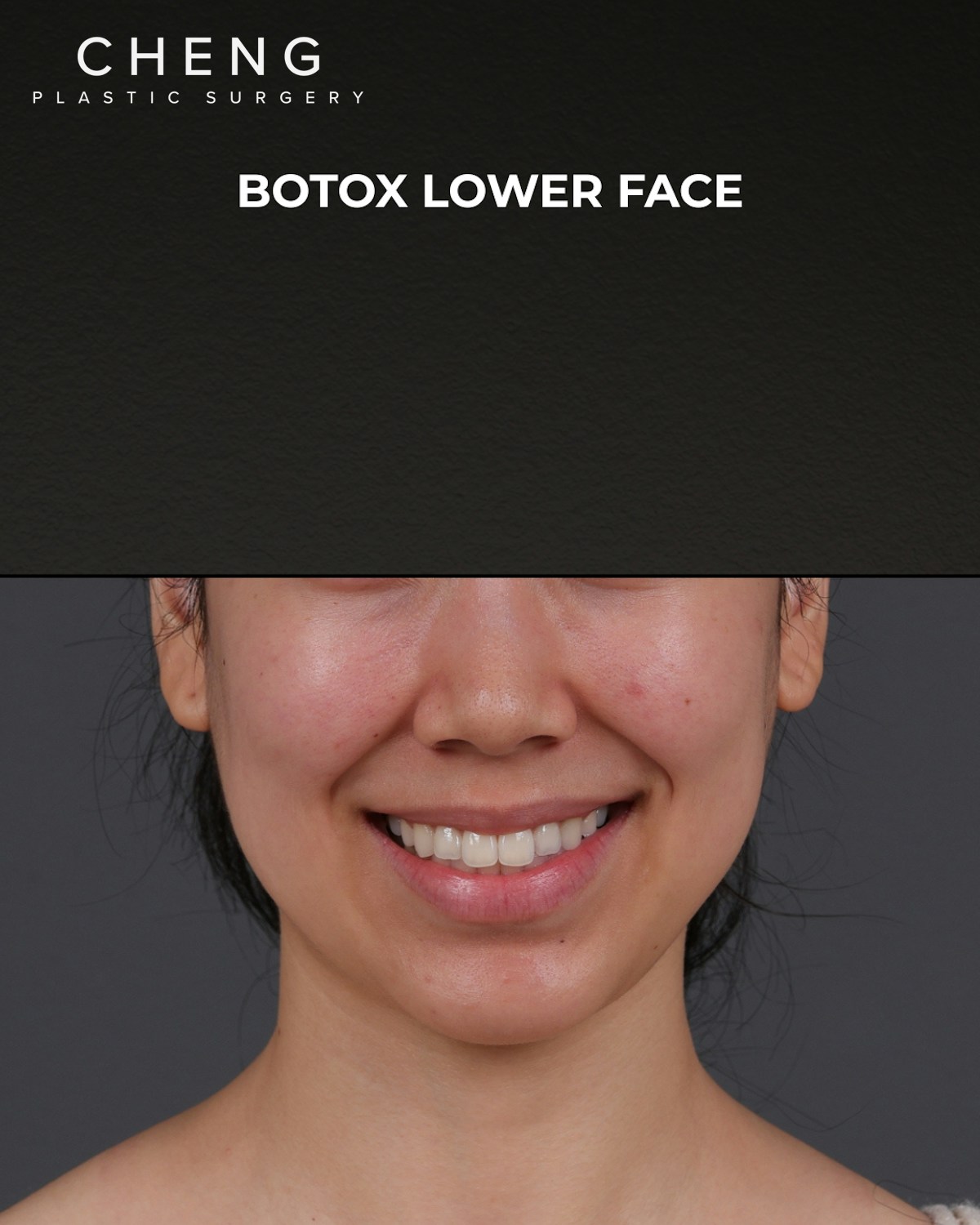 Botox and Dysport Before & After Gallery - Patient 326035 - Image 1